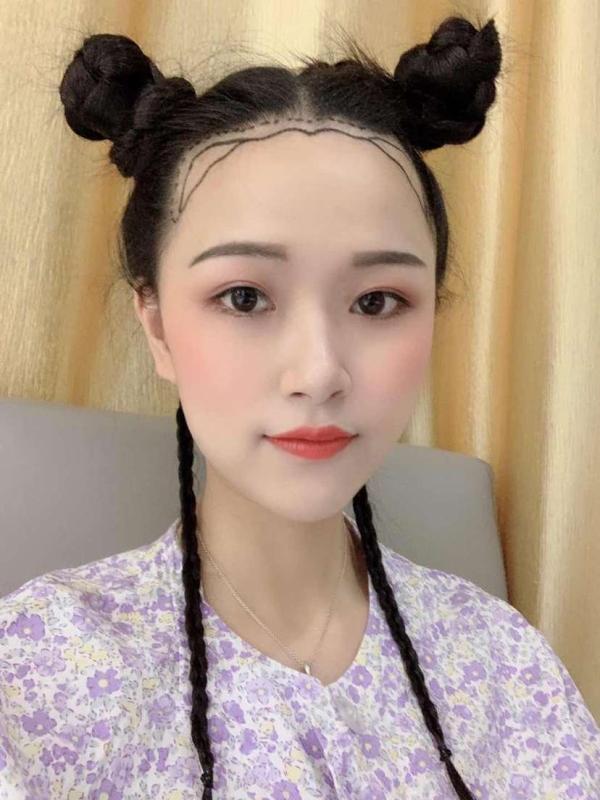 昆明植發(fā)案例,哪種發(fā)際線好看